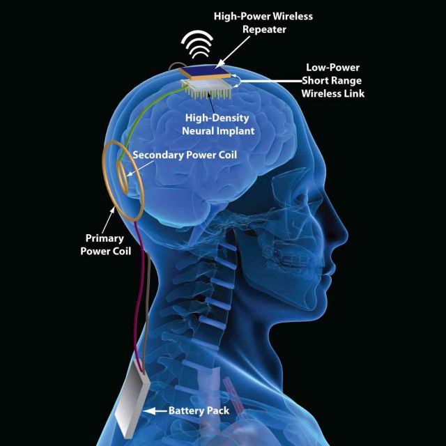 illustration of a brain implant
